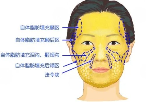 臉部填充用什么填充好？