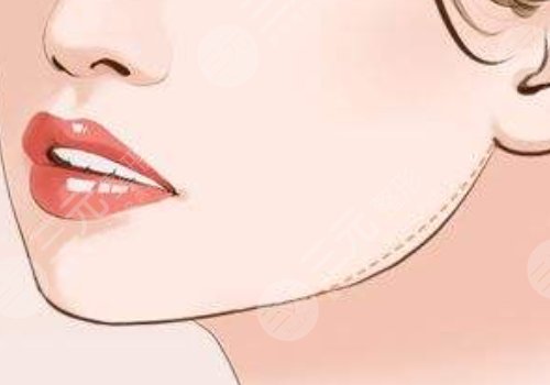 下顎線提升整形有什么做法？