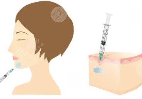 下顎線提升整形有什么做法？