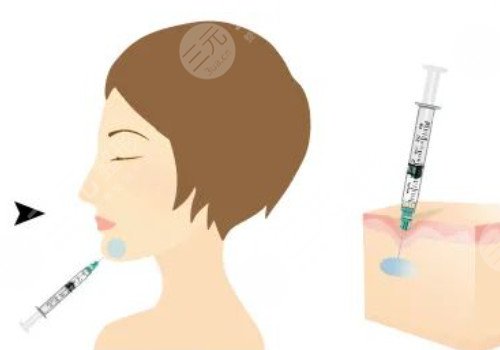 什么是面部輪廓提升針?