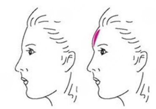 　　在日常的生活當(dāng)中，如果有的愛(ài)美人士想要通過(guò)一些好的方式來(lái)改良面部?jī)?nèi)輪廓以及外輪廓的話(huà)，可以通過(guò)吸脂以及注射一些好的物質(zhì)，還有手術(shù)的方式來(lái)進(jìn)行改良。  　　做面部?jī)?nèi)輪廓以及外輪廓，建議愛(ài)美人士在手術(shù)之前做好對(duì)于自己臉部方面的檢查，這樣的話(huà)容易根據(jù)自己實(shí)際情況來(lái)選擇合適的做這項(xiàng)手術(shù)的方式，也能夠幫助愛(ài)美人士有效的排出臉部當(dāng)中的一些脂肪，或者是改良愛(ài)美人士臉部當(dāng)做一些比較突出的骨頭。  　　達(dá)到一個(gè)比較理想的改良內(nèi)外輪廓的效果。建議愛(ài)美人士如果咬合肌比較大的話(huà)，可以通過(guò)注射一些玻尿酸以及其他的物質(zhì)來(lái)進(jìn)行緩解，這樣的話(huà)能夠起到一定的整形手術(shù)效果。