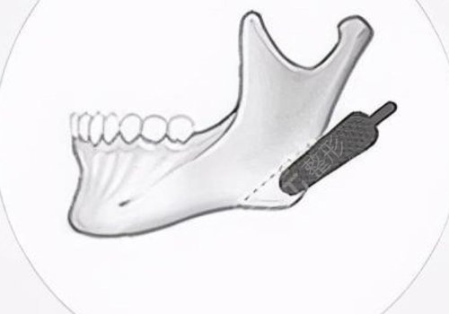 　　在日常的生活當(dāng)中，如果有的愛(ài)美人士想要通過(guò)一些好的方式來(lái)改良面部?jī)?nèi)輪廓以及外輪廓的話(huà)，可以通過(guò)吸脂以及注射一些好的物質(zhì)，還有手術(shù)的方式來(lái)進(jìn)行改良。  　　做面部?jī)?nèi)輪廓以及外輪廓，建議愛(ài)美人士在手術(shù)之前做好對(duì)于自己臉部方面的檢查，這樣的話(huà)容易根據(jù)自己實(shí)際情況來(lái)選擇合適的做這項(xiàng)手術(shù)的方式，也能夠幫助愛(ài)美人士有效的排出臉部當(dāng)中的一些脂肪，或者是改良愛(ài)美人士臉部當(dāng)做一些比較突出的骨頭。  　　達(dá)到一個(gè)比較理想的改良內(nèi)外輪廓的效果。建議愛(ài)美人士如果咬合肌比較大的話(huà)，可以通過(guò)注射一些玻尿酸以及其他的物質(zhì)來(lái)進(jìn)行緩解，這樣的話(huà)能夠起到一定的整形手術(shù)效果。