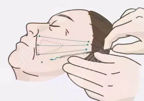 面部提升術(shù)一次大概多少錢