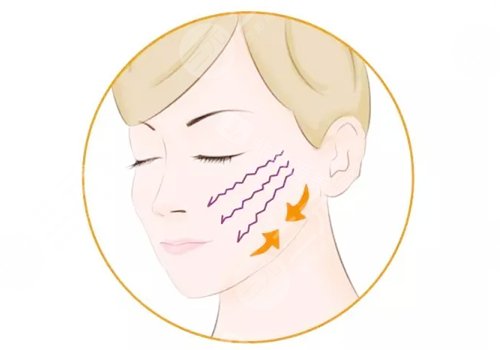 面部提升術(shù)一次大概多少錢