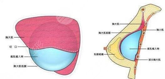 內(nèi)窺鏡隆胸.