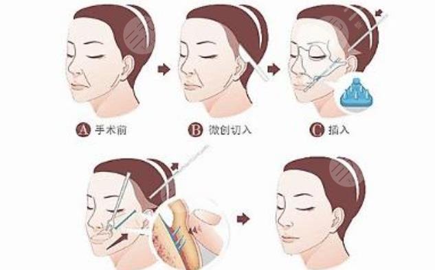 拉皮手術(shù)