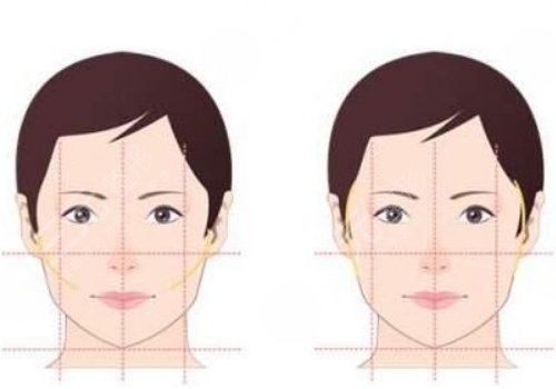 面部輪廓固定需要多少錢？