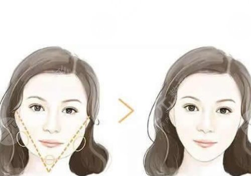 面部輪廓固定需要多少錢？