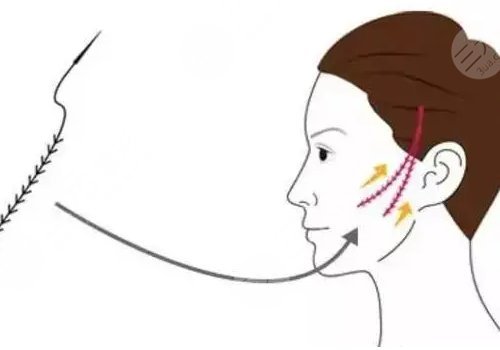 線雕適合多大年齡？