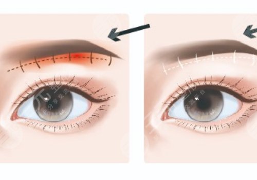 提眉術(shù)多久可以恢復自然？