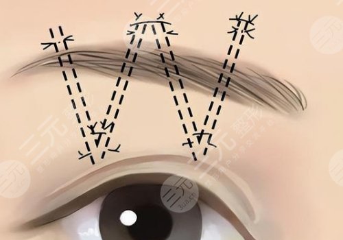 提眉術(shù)多久可以恢復自然？