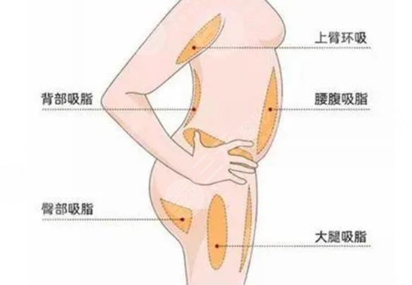 抽脂手術(shù)大概要多少錢