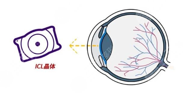 晶體植入手術(shù)的利與弊