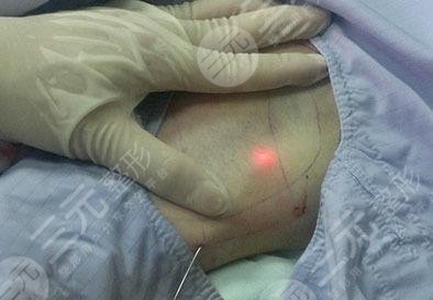 醫(yī)療方法去掉狐臭|醫(yī)美項目