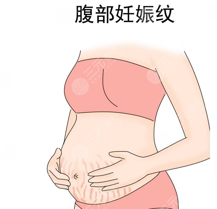 妊娠紋怎么消除