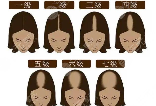 脫發(fā)1-7級程度