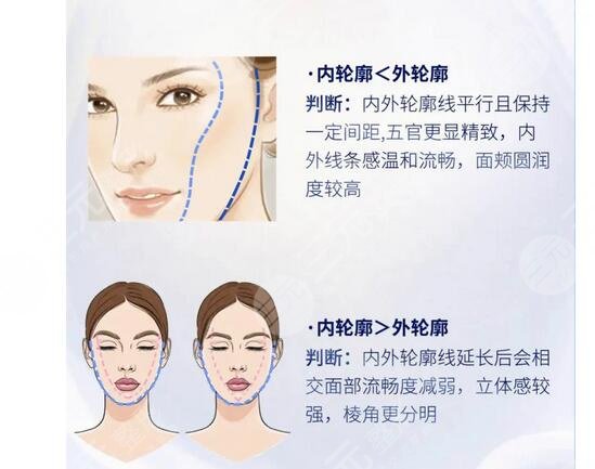 內(nèi)輪廓是指哪里部位？