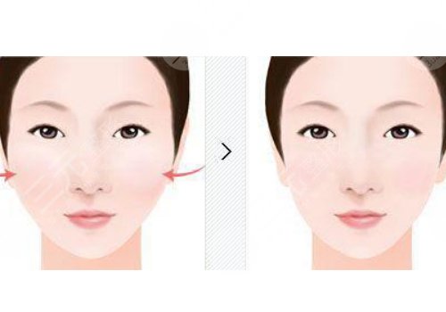 輪廓手術(shù)危險(xiǎn)嗎？