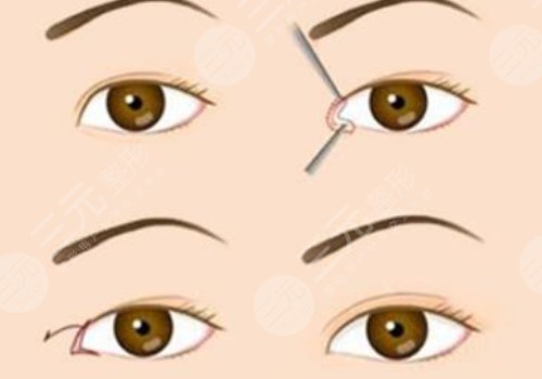 開眼角割雙眼皮恢復(fù)期要多久？