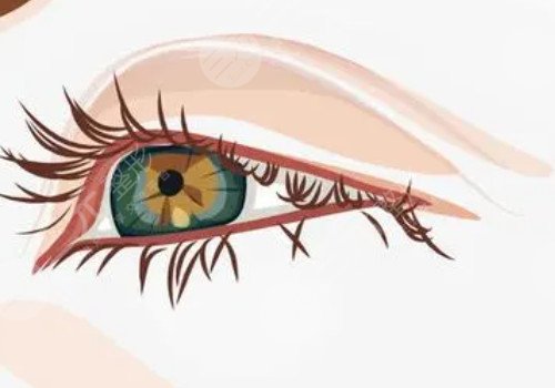 開眼角割雙眼皮恢復(fù)期要多久？