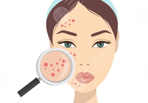 痘印怎么消除？
