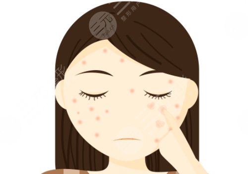 痘印怎么消除？