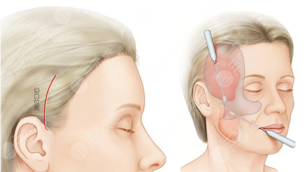 王志軍醫(yī)生拉皮案例