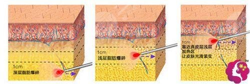 瘦肚子和腰上贅肉有效的方法