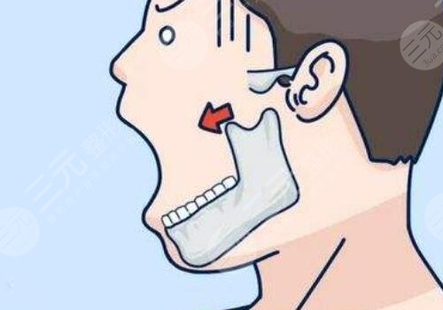 做輪廓手術(shù)多少錢(qián)費(fèi)用是多少？