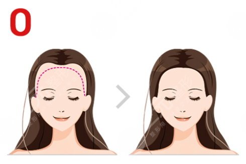 頭發(fā)怎么種?植的?植發(fā)具體操作流程