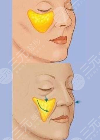 張曉建醫(yī)生脂肪修復(fù)案例