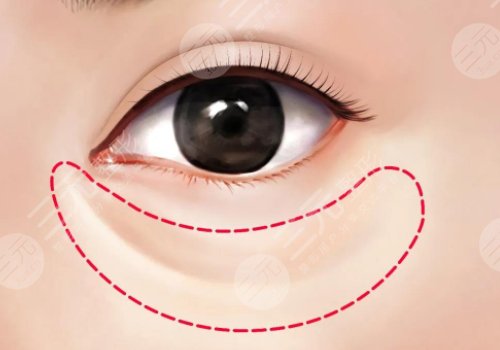 淚溝是怎么形成的？