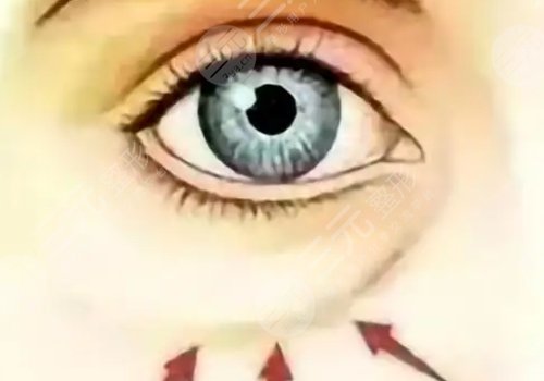 淚溝是怎么形成的？