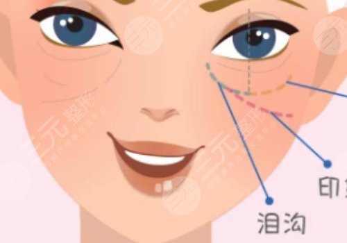 淚溝是怎么形成的？