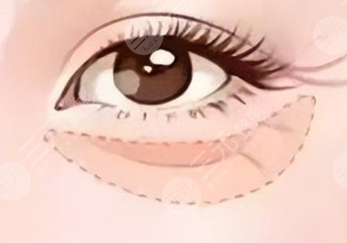 淚溝是怎么形成的？