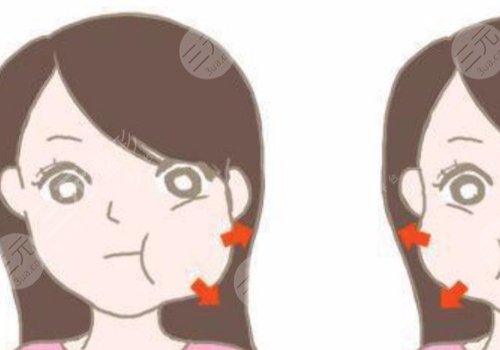 咬肌太大怎么辦如何讓咬肌變??？