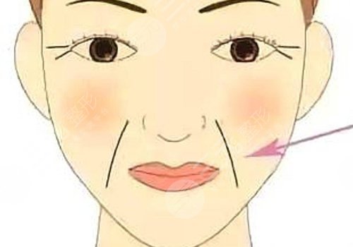 法令紋太深了有什么解決辦法？