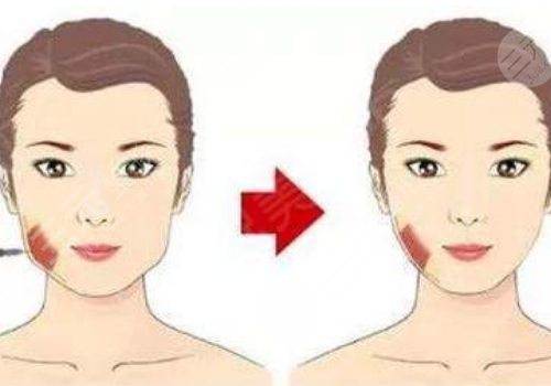 咬肌大怎么瘦下來(lái)