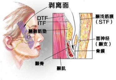 面部提升術(shù)
