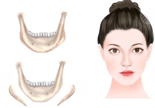 下頜角手術(shù)后頭套要戴多久？3-4周的時間？