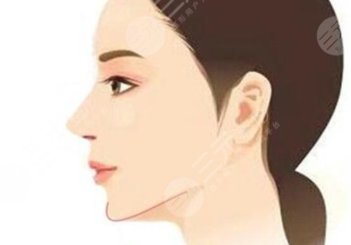 下頜角手術(shù)后頭套要戴多久？