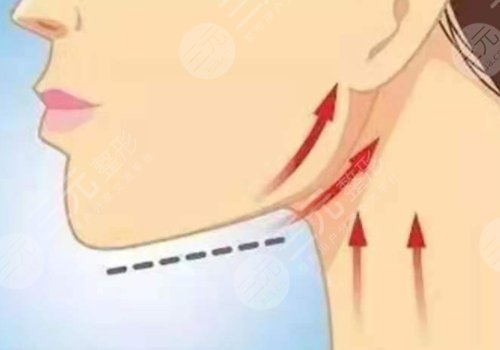 下頜緣提升怎么打？