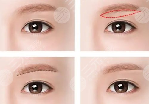 眉弓骨填充前后照片(案例)