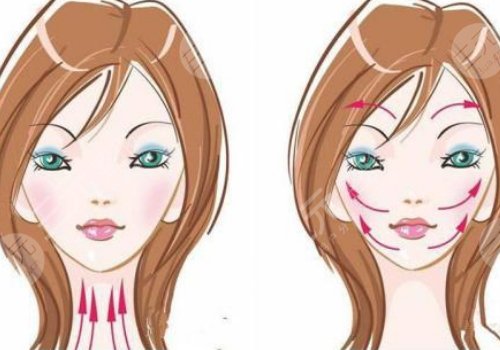 小v臉提升怎么做多少錢？