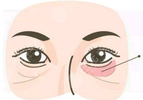 去黑眼圈和眼袋有效的方法是什么？眼周抗衰指南！