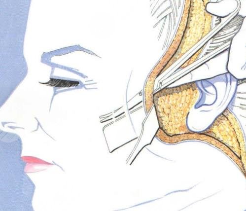 內(nèi)外輪廓固定