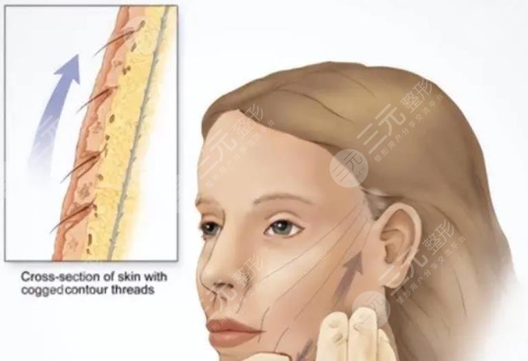 吳佳君醫(yī)生拉皮手術案例
