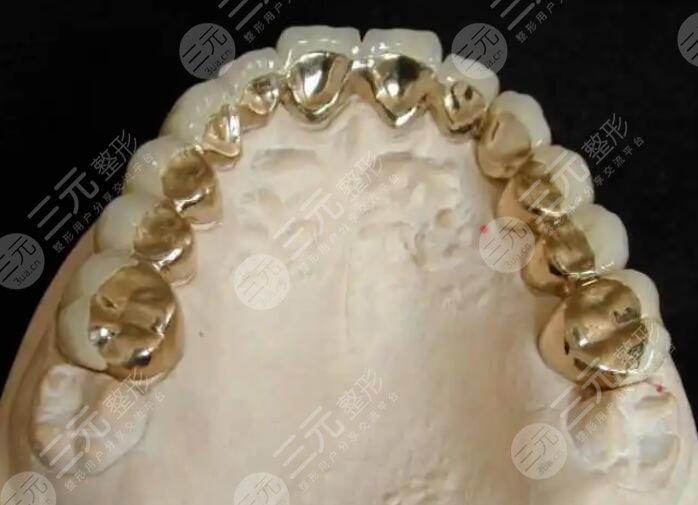 金鈀烤瓷牙價格一般是多少?