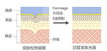 面部凹陷除了填充還有啥好辦法