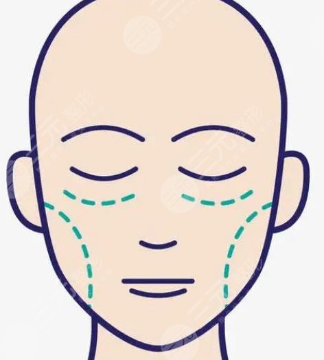 雙燕尾拉皮手術(shù)多少錢